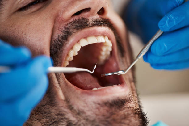 Best Emergency Dentist for Lost Fillings or Crowns in Portsmouth, VA